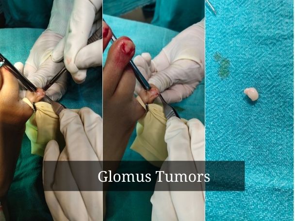 Glomus Tumors