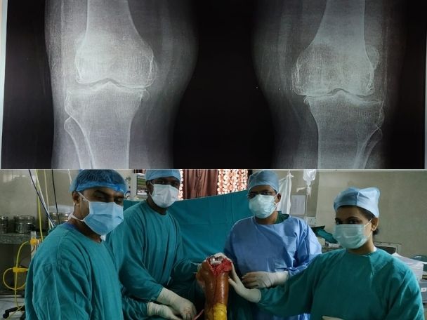 knee transplant