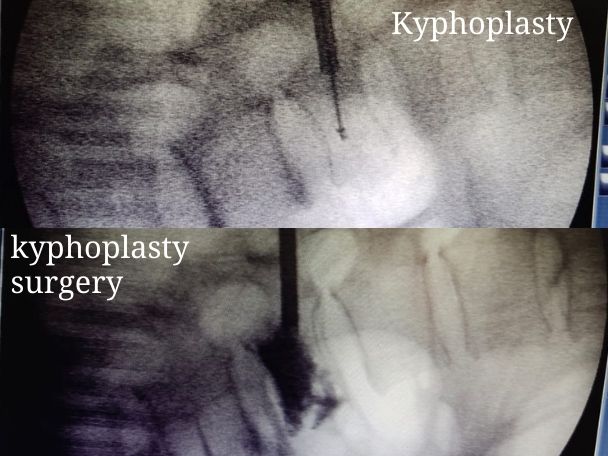 kyphoplasty surgery